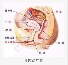 患有盆腔炎症怎么办